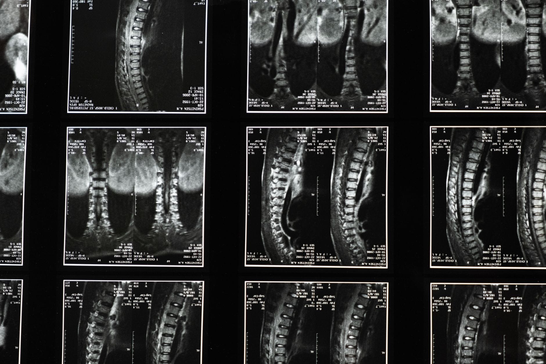 Zdjęcie rentgenowskie kręgosłupa wykorzystywane w diagnostyce urazów